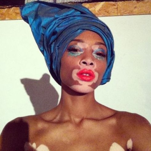 Невероятная американская модель с пигментацией кожи (Фото) - 4 Невероятная американская модель с пигментацией кожи (Фото)