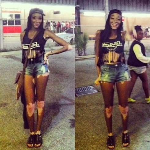 Невероятная американская модель с пигментацией кожи (Фото) - 8 Невероятная американская модель с пигментацией кожи (Фото)