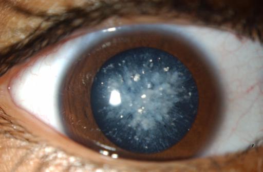 С катарактой у детей научились бороться при помощи стволовых клеток - 1