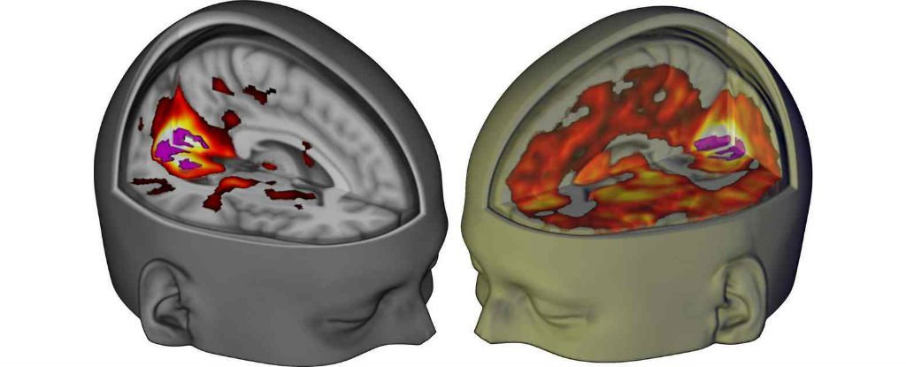 Сканы мозга показали, как ЛСД действует на сознание - 1