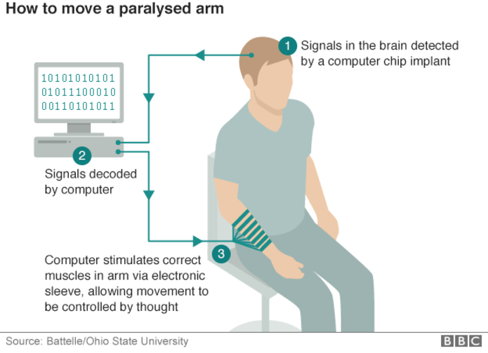 Мозговой имплантат впервые позволил парализованному человеку управлять рукой - 2