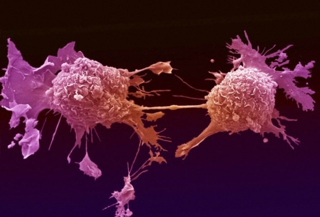Искусственный интеллект помогает диагностировать рак - 1
