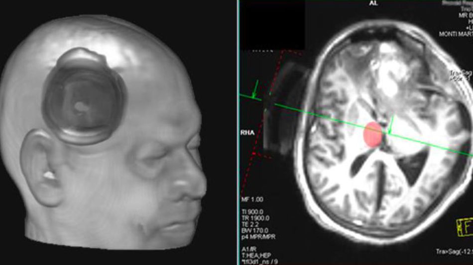 Триггер для сознания? 25-летнего парня вывели из комы, фокусируя ультразвук на небольшом участке в центре мозга - 3