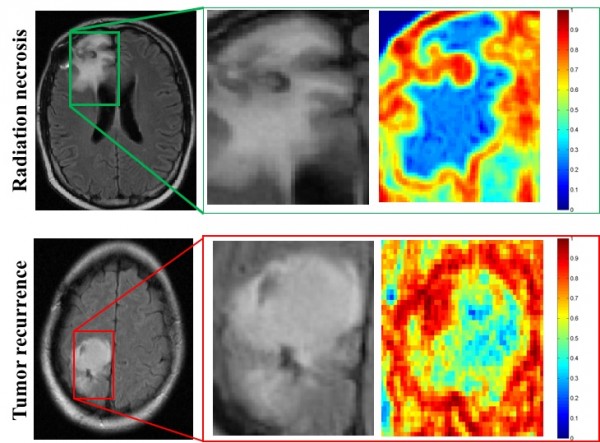 Компьютерная программа лучше врачей диагностирует рак мозга по снимкам МРТ - 1