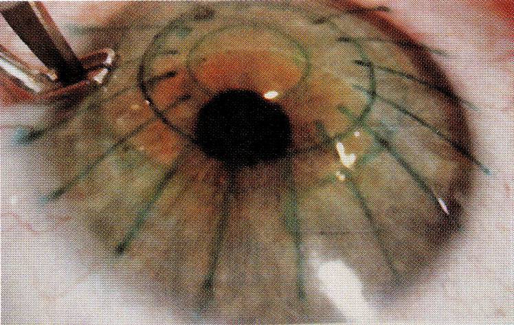 История операций по коррекции зрения: сравнение рисков и побочных эффектов - 2