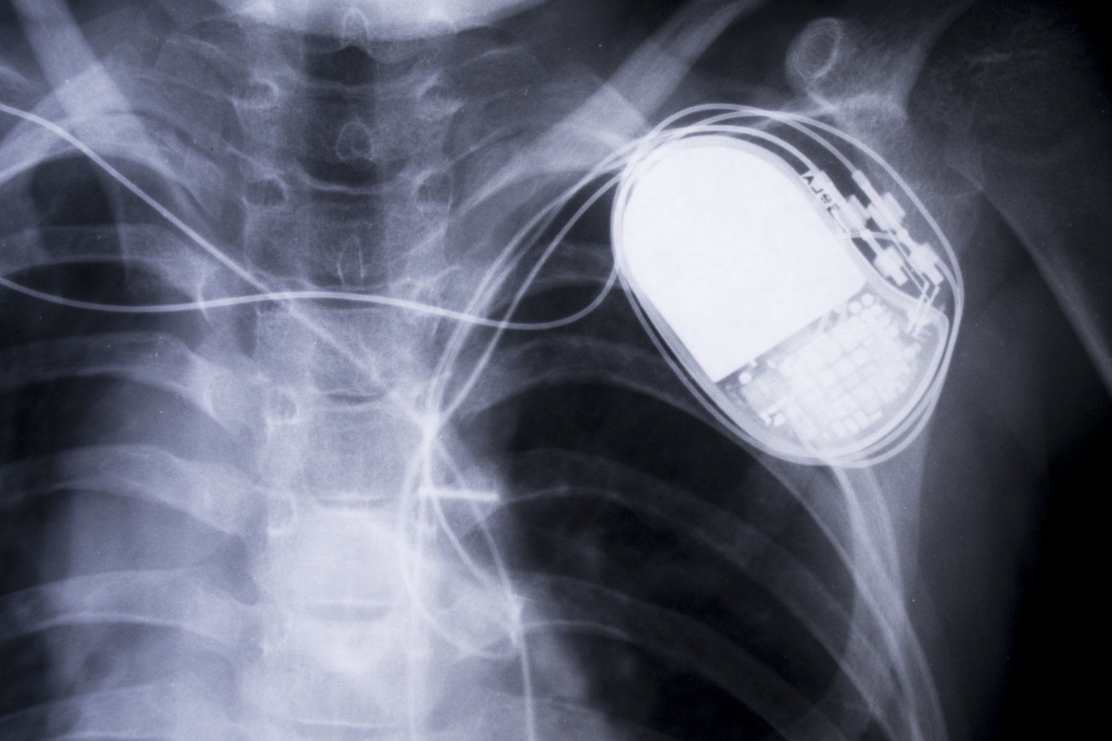 Взлом кардиостимулятора не так сложен, как может показаться - 2