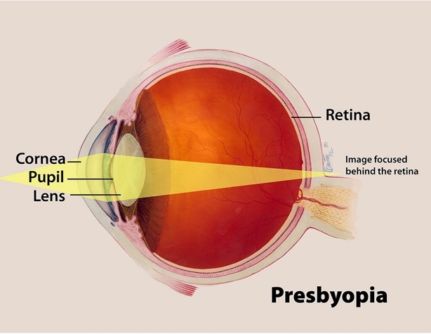 Пресбиопия: «климакс» глаз у мужчин и женщин - 1