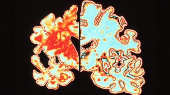 Исследователи болезни Альцгеймера получили премию за прорыв