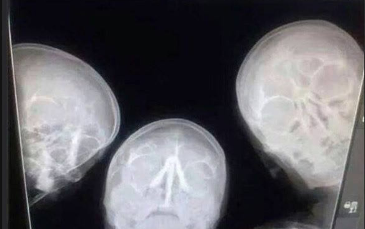 Учёные ищут способ снизить количество радиации при рентгеновских снимках - 1