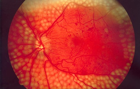 Панретинальная лазерная коагуляция сетчатки глаза