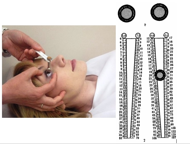 Тонометрия — измерение внутриглазного давления при глаукоме