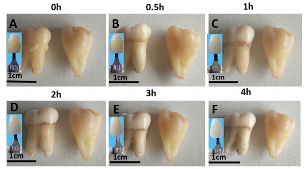 Китайские ученые предложили отбеливать зубы наночастицами