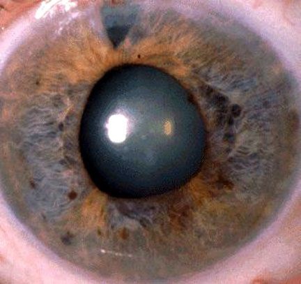 После операции на глаза при глаукоме