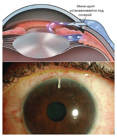 Мини-шунты в хирургии глаукомы