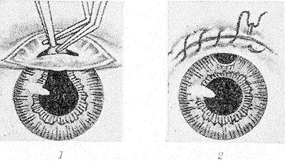 Иридэктомия - метод хирургического лечения глаукомы