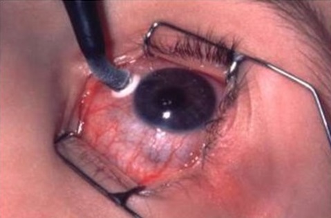 Циклокриокоагуляция при глаукоме