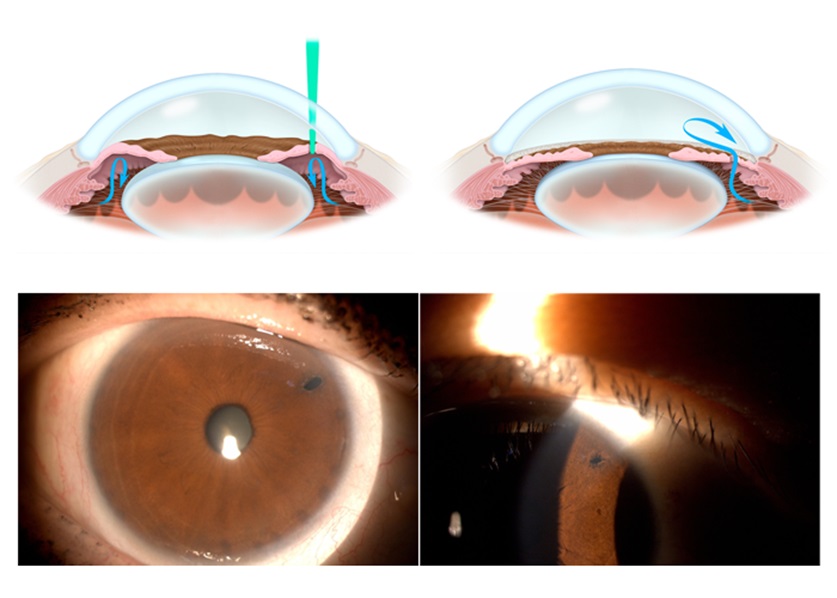 лазерная иридэктомия - ЛИЭ при глаукоме