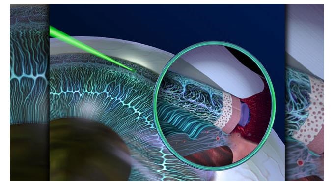 СЛТ - селективная лазерная трабекулопластика при глаукоме