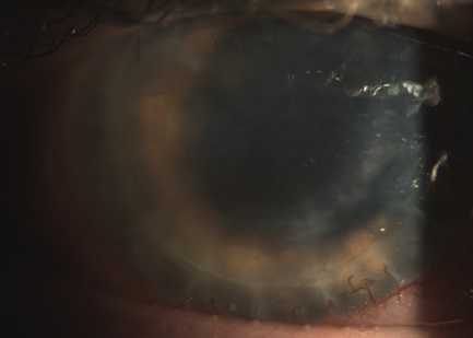 Биомикроскопия роговицы глаза