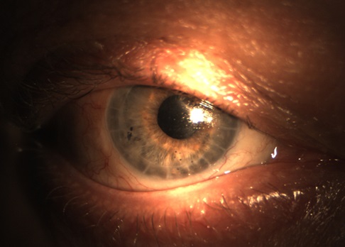 Глаз пациента после операции