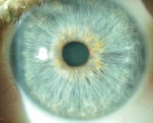 Состояние глаз и острота зрения после лазерной коррекции