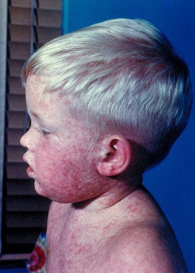 К чему приводит отказ от вакцинации: как страдают дети