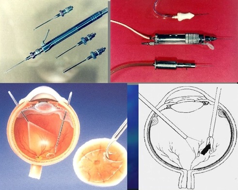 Инструменты для проведения операции витрэктомии сетчатки глаза