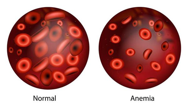 изображение здоровых и больных анемией эритроцитов