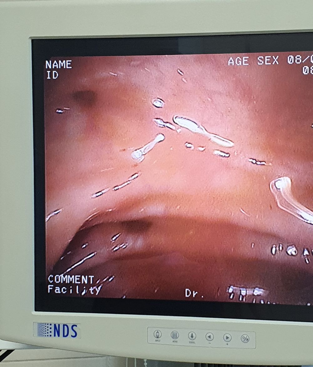 Колоноскопия. О деликатной теме без насмешек - 4 Колоноскопия. О деликатной теме без насмешек - 4