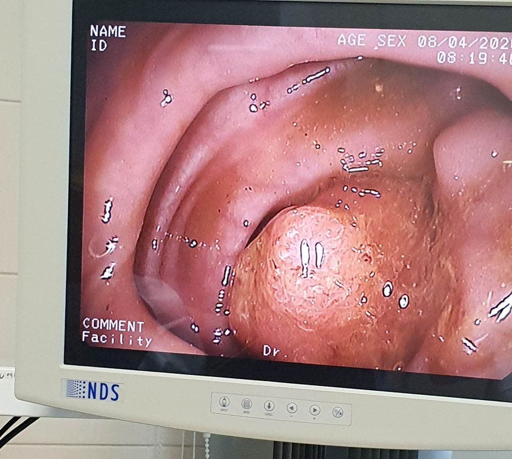 Колоноскопия. О деликатной теме без насмешек - 5 Колоноскопия. О деликатной теме без насмешек - 5