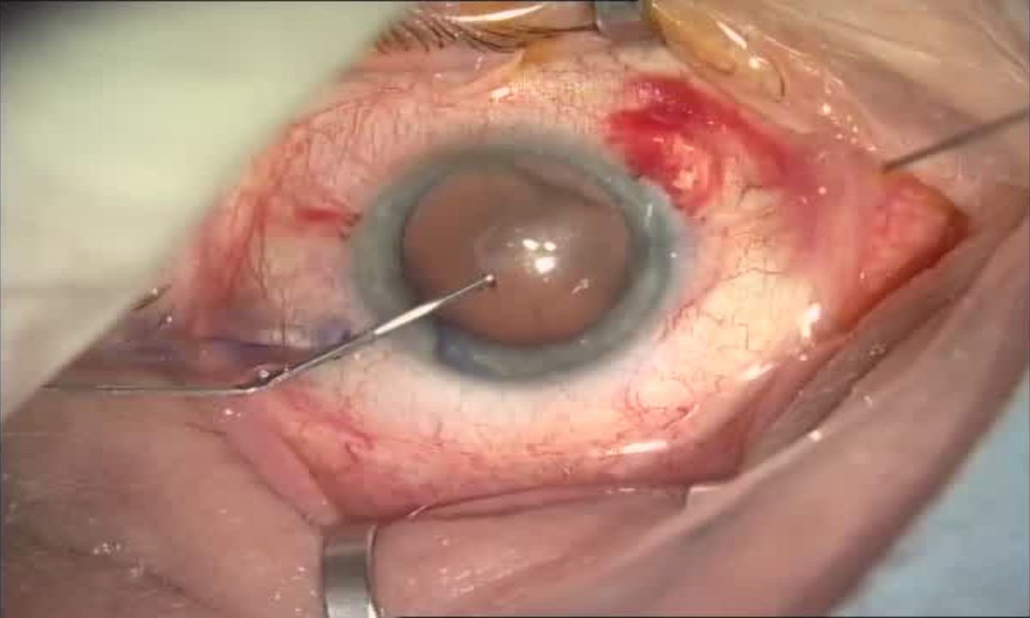Операция «Глаз»: руки, линза и алмаз. Контрнаступление на катаракту - 10