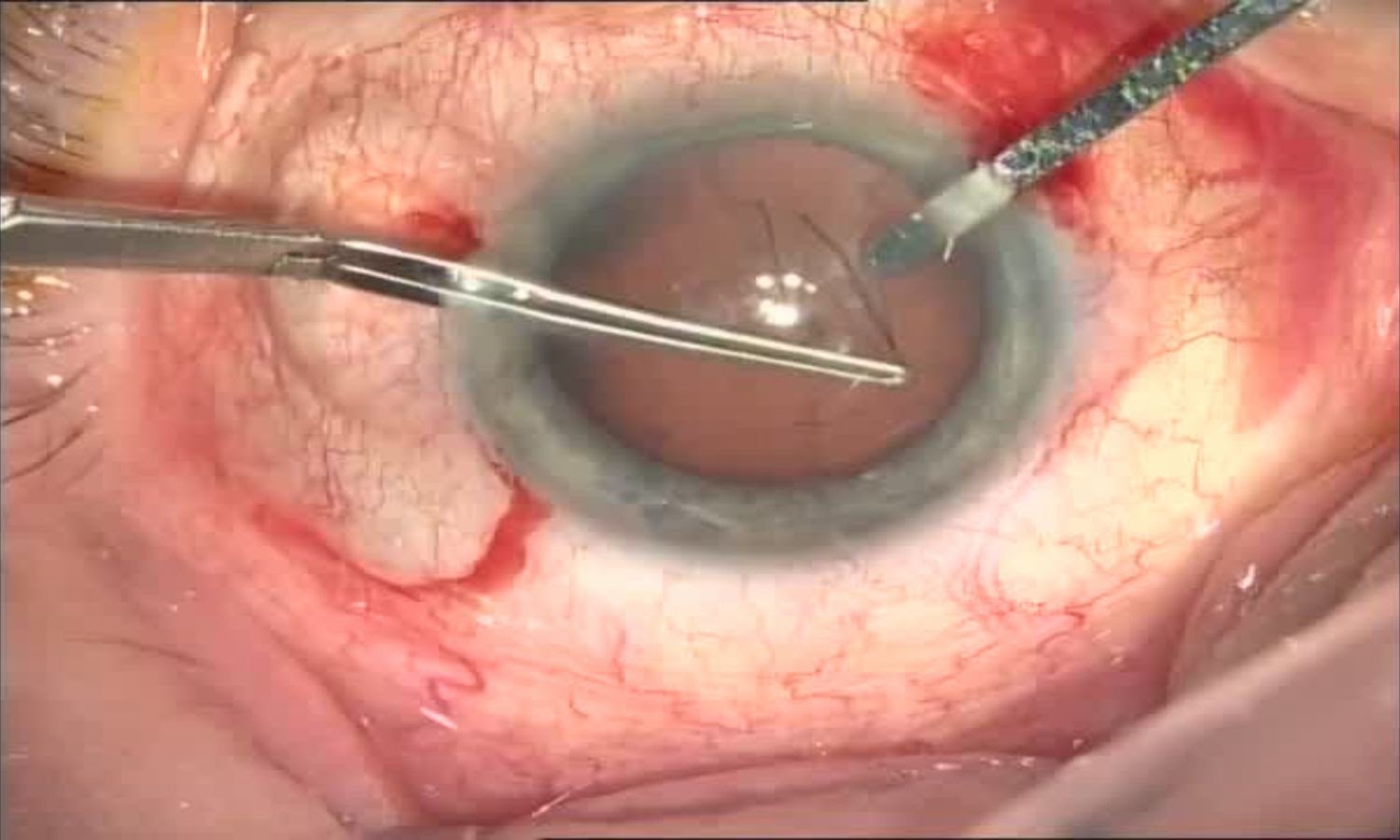 Операция «Глаз»: руки, линза и алмаз. Контрнаступление на катаракту - 13