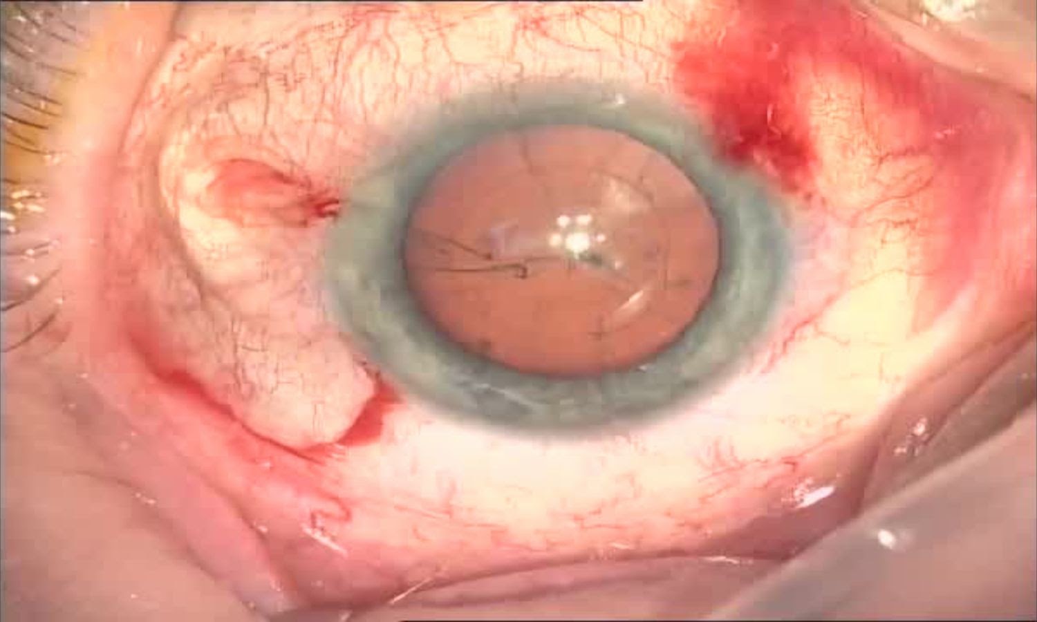 Операция «Глаз»: руки, линза и алмаз. Контрнаступление на катаракту - 14
