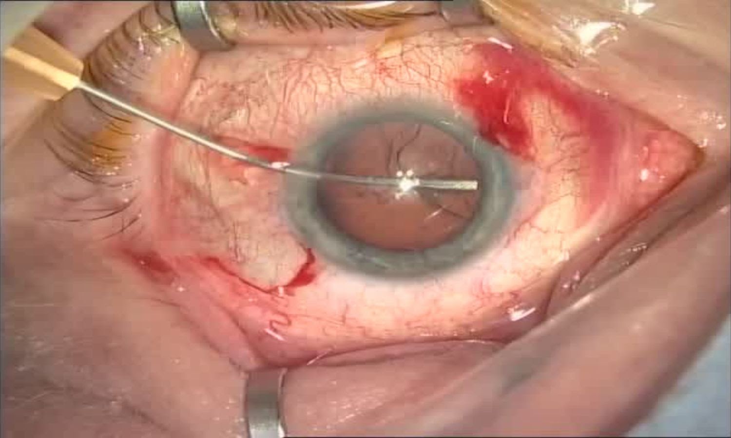 Операция «Глаз»: руки, линза и алмаз. Контрнаступление на катаракту - 15