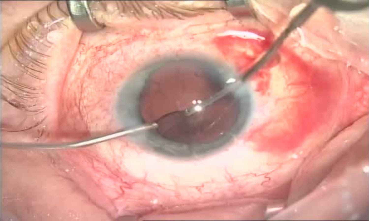 Операция «Глаз»: руки, линза и алмаз. Контрнаступление на катаракту - 19