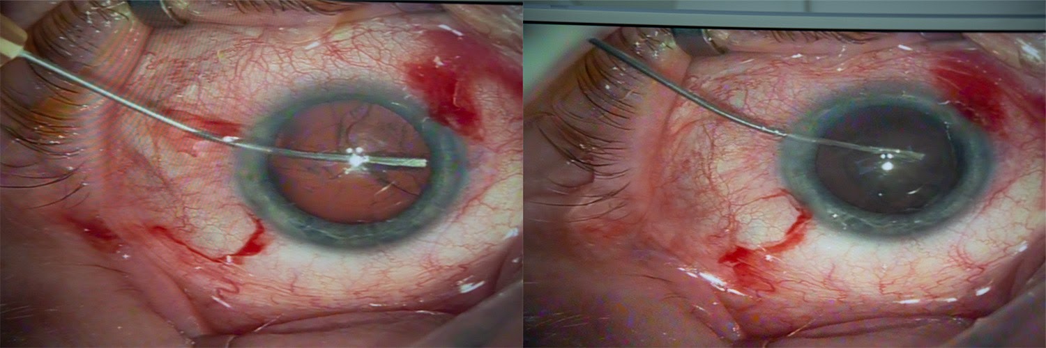 Операция «Глаз»: руки, линза и алмаз. Контрнаступление на катаракту - 20