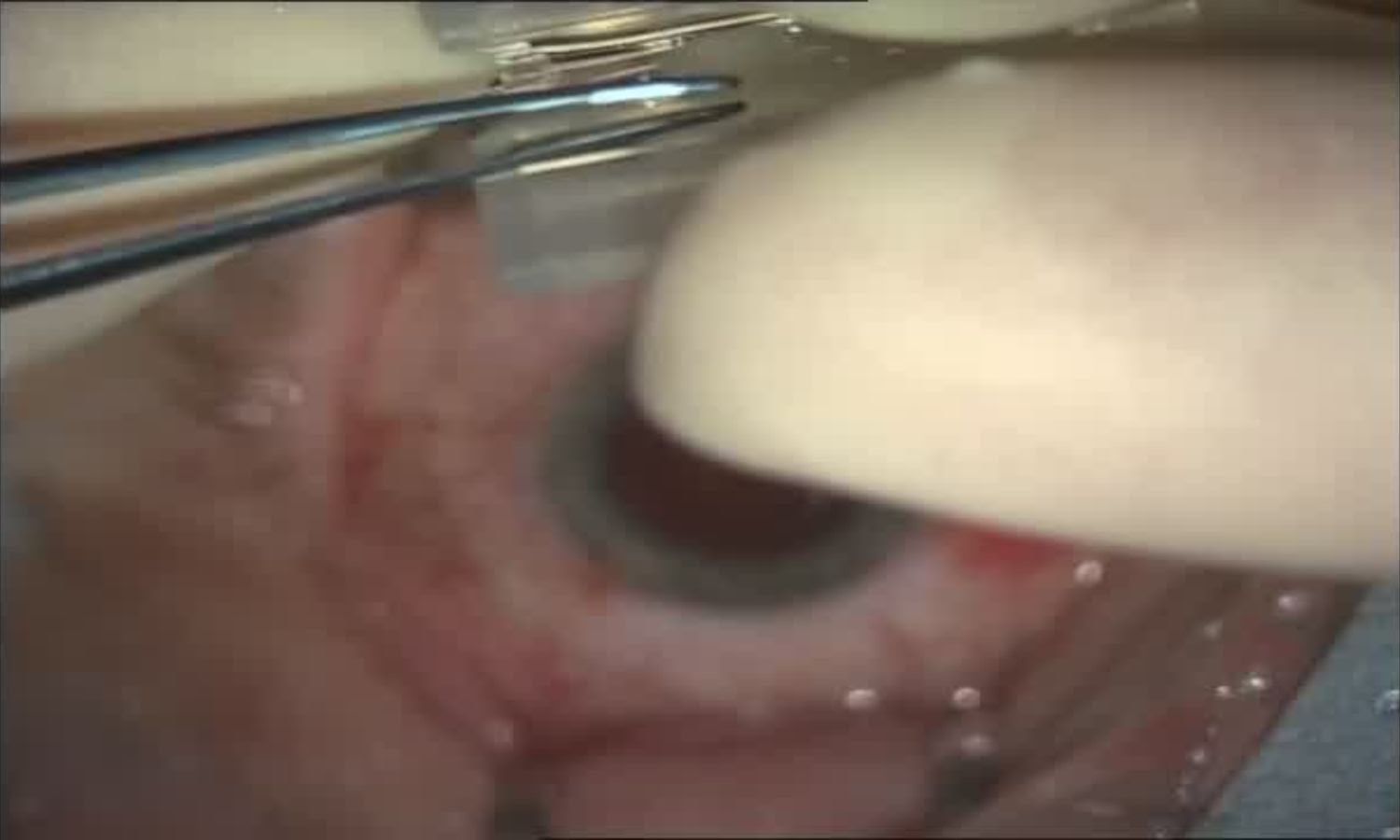 Операция «Глаз»: руки, линза и алмаз. Контрнаступление на катаракту - 23