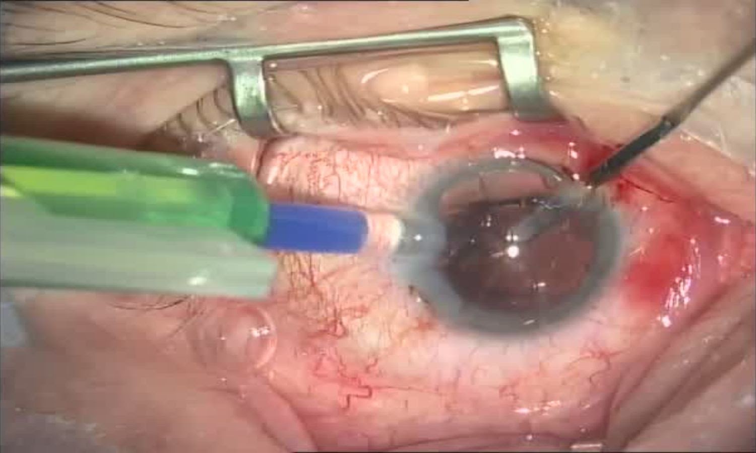 Операция «Глаз»: руки, линза и алмаз. Контрнаступление на катаракту - 24