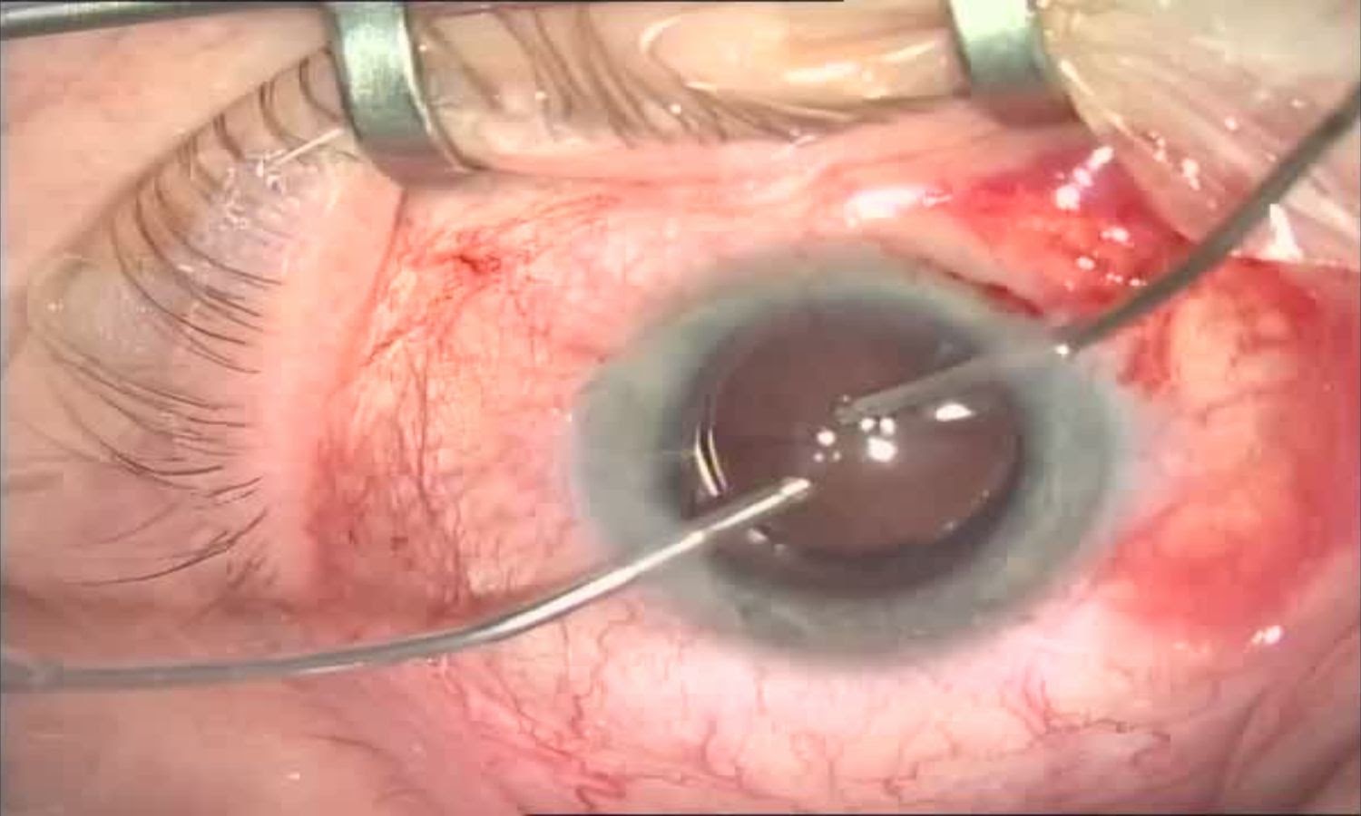 Операция «Глаз»: руки, линза и алмаз. Контрнаступление на катаракту - 25