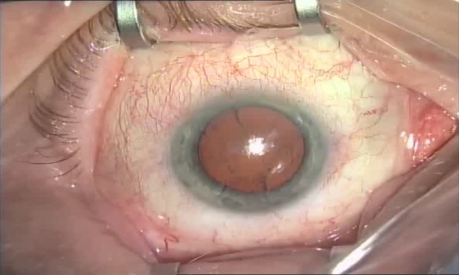 Операция «Глаз»: руки, линза и алмаз. Контрнаступление на катаракту - 5