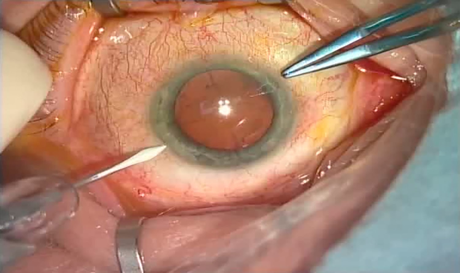 Операция «Глаз»: руки, линза и алмаз. Контрнаступление на катаракту - 8