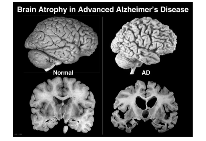 Болезнь Альцгеймера - 3