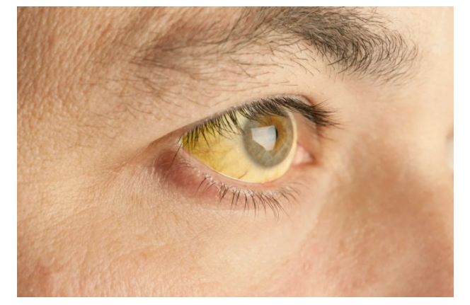 «Красивые глаза» как симптом болезни - 10