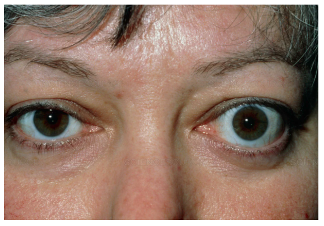 «Красивые глаза» как симптом болезни - 11