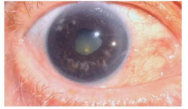 «Красивые глаза» как симптом болезни - 12