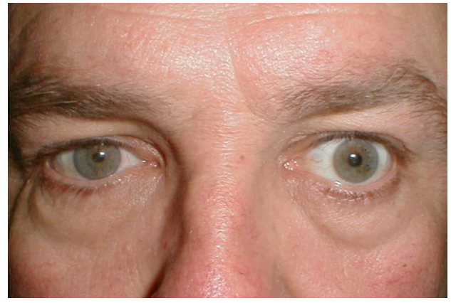 «Красивые глаза» как симптом болезни - 4