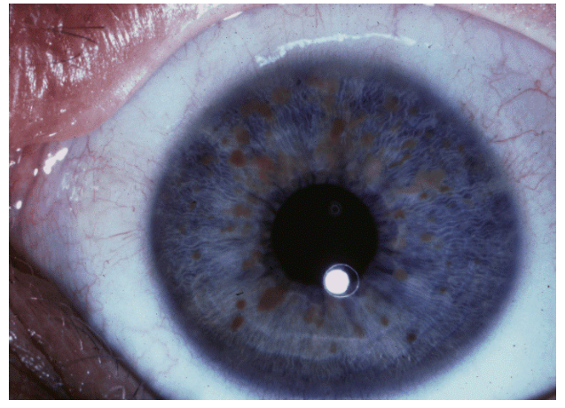 «Красивые глаза» как симптом болезни - 6