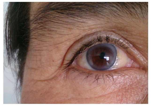 «Красивые глаза» как симптом болезни - 9