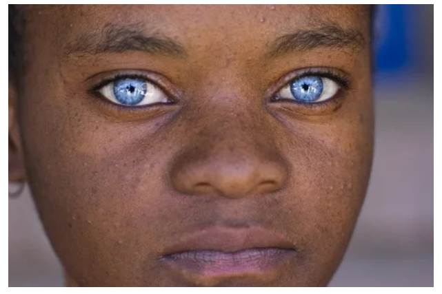 «Красивые глаза» как симптом болезни - 1