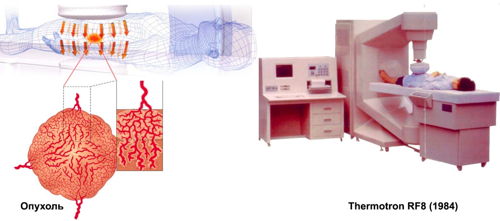 Иллюстрация того, как выглядит сосудистая сетка новообразования в тазовой области и аппарат гипертермии на частоте 8 МГц для выжигания подобных опухолей.